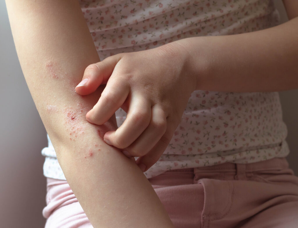 Environmental and Food Allergies