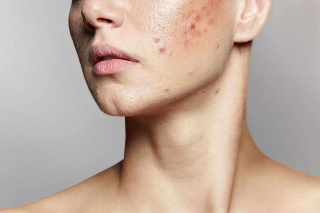 Acne