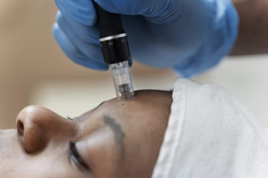 person-getting-micro-needling-beauty-treatment(1)